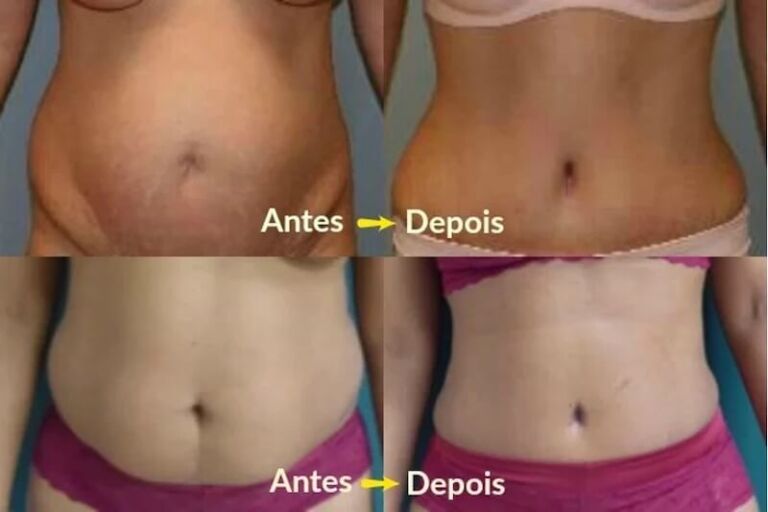 Abdominoplastia O que é Preço Antes e Depois Fotos em Tudo Sobre Cirurgia Plástica