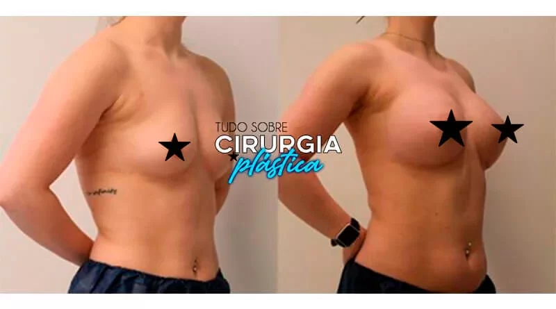 Mamoplastia de Aumento: O que é, Preço, Antes e Depois com fotos 2022