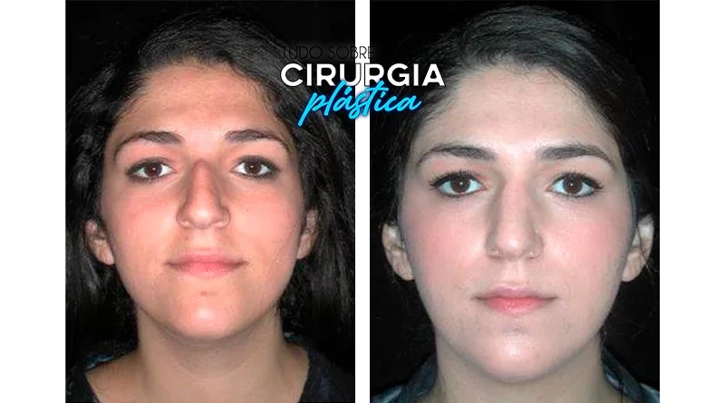 Rinoplastia: O que é, Preço, Antes e Depois com Fotos 2022