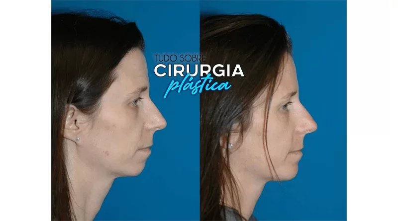 Mentoplastia O que é, Preço, Antes e Depois com Fotos 2022