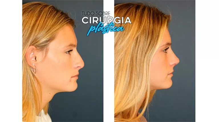 Rinoplastia: O que é, Preço, Antes e Depois com Fotos - Tudo Sobre ...