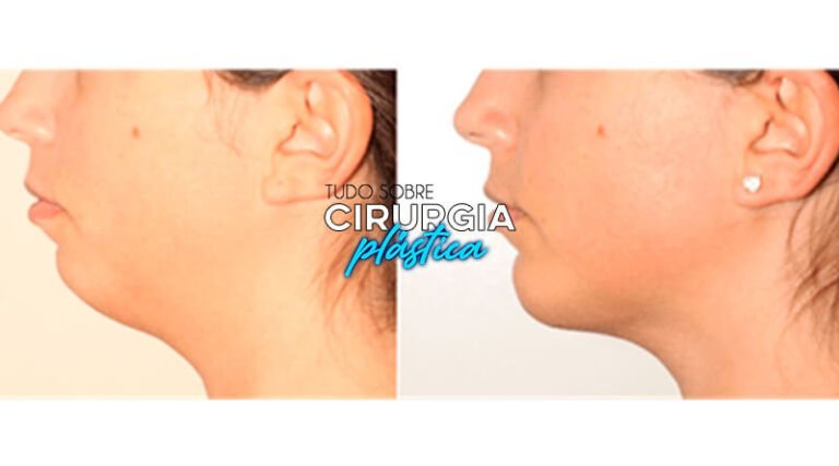 Lipoaspiração de Papada: O que é, Preço, Antes e Depois Com Fotos em