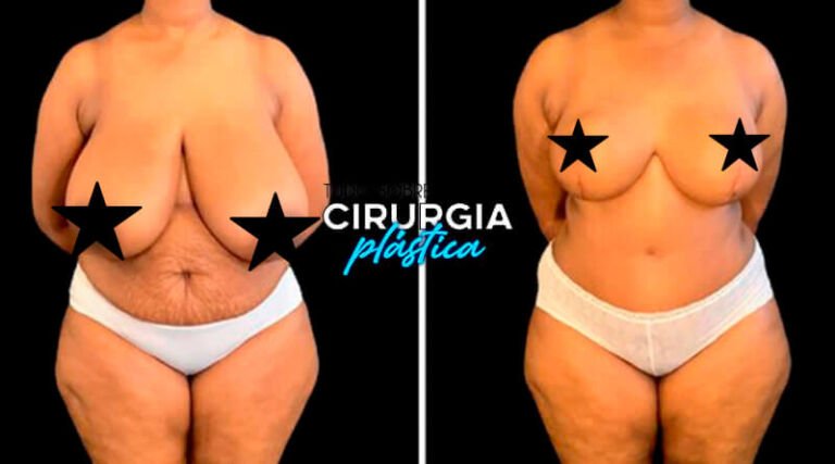 Mamoplastia Redutora O Que Pre O Antes E Depois Com Fotos Em