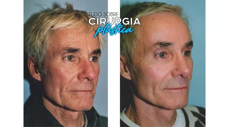 Rinoplastia: O que é, Preço, Antes e Depois com Fotos 2022