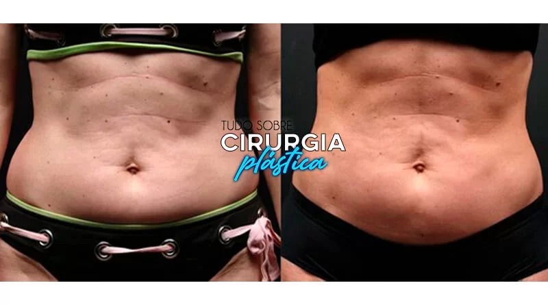 Vibrolipo: O que é, Preço, Antes e Depois com fotos 2022