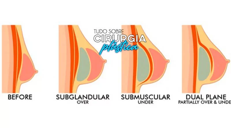 Prótese de Silicone: Tipos, Valor, Antes e Depois com Fotos 2022