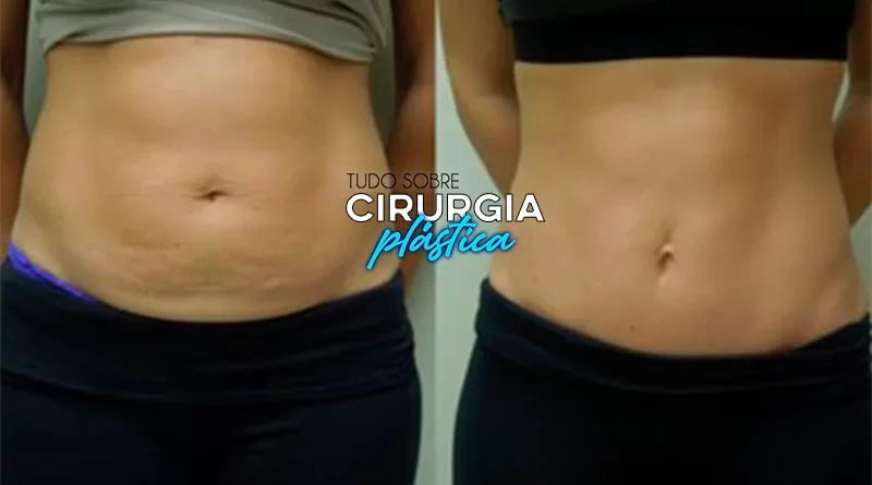 Miniabdominoplastia: O que é, Preço, Antes e Depois com Fotos