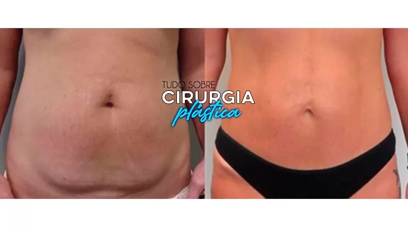 miniabdominoplastia-o-que-e-preco-antes-e-depois-com-fotos