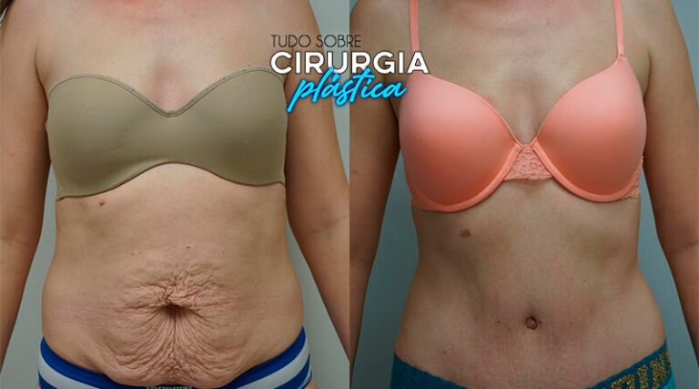 Abdominoplastia Antes e Depois com Fotos em 2026 - TS Cirurg. Plástica