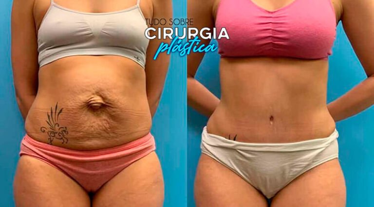 Abdominoplastia Antes e Depois com Fotos em 2026 - TS Cirurg. Plástica