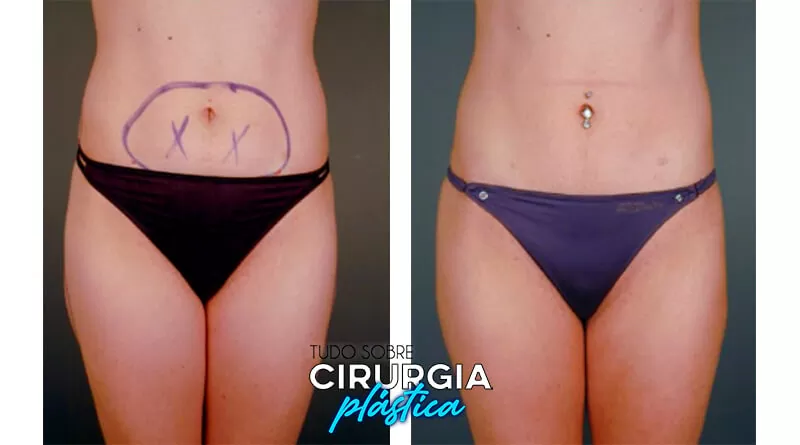 Mini lipo: o que é, valor, antes e depois com fotos 2022