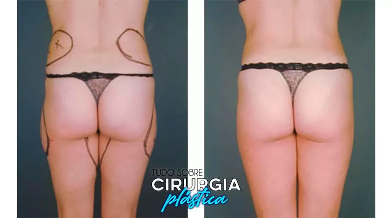 Mini lipo: o que é, valor, antes e depois com fotos 2022