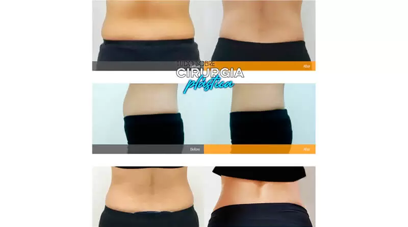 Mini lipo: o que é, valor, antes e depois com fotos 2022